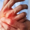 How to Prevent Arthritis from Developing