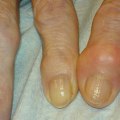When Does Arthritis Usually Start?