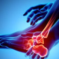How to Reduce Your Risk of Developing Arthritis