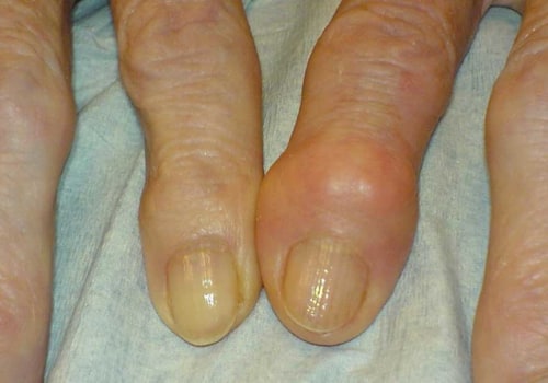 When Does Arthritis Usually Start?