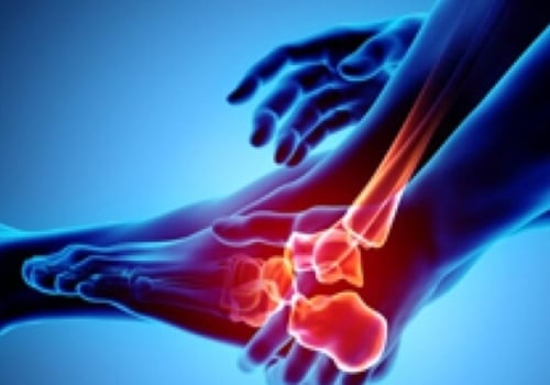 How to Reduce Your Risk of Developing Arthritis